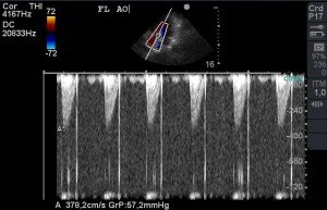 estenose-aortica-EA3-mobilevet
